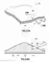 Fig. 26 - Methods and systems for submucosal implantation of a device for diagnosis and treatment with a therapeutic agent