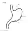 Fig. 34 - Methods and systems for submucosal implantation of a device for diagnosis and treatment with a therapeutic agent