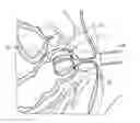 Fig. 01 - SOLUBLE MATERIAL INSERTION AID FOR BALLOON CATHETER