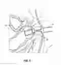 Fig. 04 - SOLUBLE MATERIAL INSERTION AID FOR BALLOON CATHETER