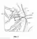 Fig. 05 - SOLUBLE MATERIAL INSERTION AID FOR BALLOON CATHETER