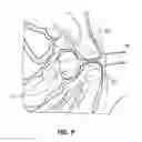 Fig. 06 - SOLUBLE MATERIAL INSERTION AID FOR BALLOON CATHETER