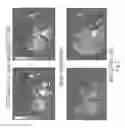 Fig. 03 - Dendritic cell tumor injection (DCTI) therapy