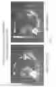 Fig. 07 - Dendritic cell tumor injection (DCTI) therapy