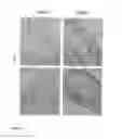Fig. 05 - Method for applying flowable hydrogels to a cornea