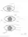 Fig. 07 - Method for applying flowable hydrogels to a cornea