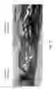 Fig. 17 - DIODE LASER SYSTEMS AND METHODS FOR ENDOSCOPIC TREATMENT OF TISSUE