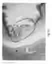 Fig. 18 - DIODE LASER SYSTEMS AND METHODS FOR ENDOSCOPIC TREATMENT OF TISSUE