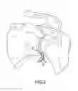 Fig. 05 - MICROFRACTURE AWL