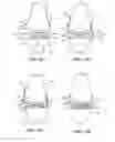 Fig. 12 - Patient selectable joint arthroplasty devices and surgical tools