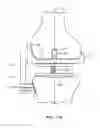 Fig. 51 - Patient selectable joint arthroplasty devices and surgical tools