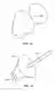 Fig. 55 - Patient selectable joint arthroplasty devices and surgical tools