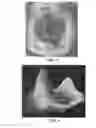 Fig. 05 - PATIENT SELECTABLE JOINT ARTHROPLASTY DEVICES AND SURGICAL TOOLS