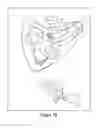 Fig. 03 - Method and apparatus for cochlear implant surgery