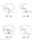 Fig. 08 - METHODS FOR REDUCTION OF GASTRIC LUMEN