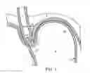 Fig. 02 - METHODS AND SYSTEMS FOR TREATING HIATAL HERNIAS