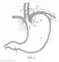 Fig. 04 - METHODS AND SYSTEMS FOR TREATING HIATAL HERNIAS