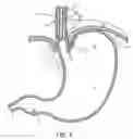 Fig. 06 - METHODS AND SYSTEMS FOR TREATING HIATAL HERNIAS