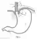 Fig. 07 - METHODS AND SYSTEMS FOR TREATING HIATAL HERNIAS