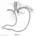 Fig. 08 - METHODS AND SYSTEMS FOR TREATING HIATAL HERNIAS