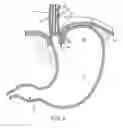 Fig. 09 - METHODS AND SYSTEMS FOR TREATING HIATAL HERNIAS