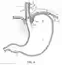 Fig. 10 - METHODS AND SYSTEMS FOR TREATING HIATAL HERNIAS