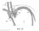 Fig. 11 - METHODS AND SYSTEMS FOR TREATING HIATAL HERNIAS
