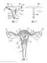 Fig. 02 - METHOD AND APPARATUS FOR CREATING INTRAUTERINE ADHESIONS