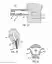 Fig. 07 - METHOD AND APPARATUS FOR CREATING INTRAUTERINE ADHESIONS