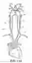 Fig. 16 - Plaque removal device with rotatable cutting element