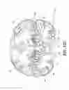Fig. 18 - Plaque removal device with rotatable cutting element