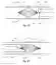 Fig. 16 - Implantable lumen filter with enhanced durability