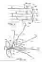 Fig. 03 - Vein filter