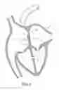 Fig. 02 - Heart occlusion devices