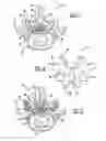 Fig. 02 - Minimally invasive vertebral laminar reconstructive plate