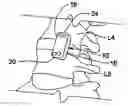 Fig. 01 - Antero-lateral plating systems and methods for spinal stabilization
