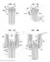 Fig. 10 - Pedicle screw assembly and methods therefor