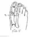 Fig. 04 - METHODS AND DEVICES FOR TREATING HALLUX VALGUS