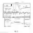Fig. 10 - Subcutaneous cardiac sensing and stimulation system