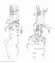 Fig. 02 - DEVICE AND METHOD FOR ASSISTING IN FLEXOR TENDON REPAIR AND REHABILITATION