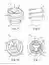 Fig. 05 - Implant positioning systems for orienting prosthesis