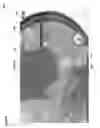 Fig. 07 - Adjusting dental prostheses based on soft tissue
