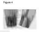 Fig. 05 - Dental repair material