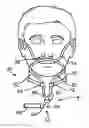 Fig. 01 - Method and device for non-invasive ventilation with nasal interface