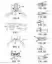 Fig. 04 - Method and device for non-invasive ventilation with nasal interface