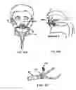 Fig. 17 - Method and device for non-invasive ventilation with nasal interface