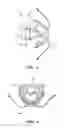 Fig. 03 - Snoring and sleep apnea prevention device