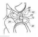 Fig. 01 - Corded earplugs