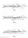 Fig. 03 - Method of isolating a wellbore with solid acid for fracturing