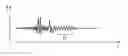 Fig. 01 - METHOD FOR RECONSTRUCTING A SPEECH SIGNAL AND HEARING DEVICE